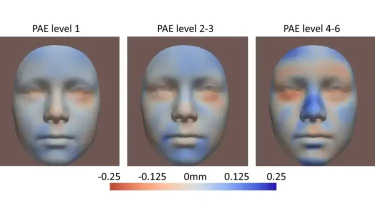 Νέα σοκαριστική έρευνα για το αλκοόλ κατά τη διάρκεια της εγκυμοσύνης