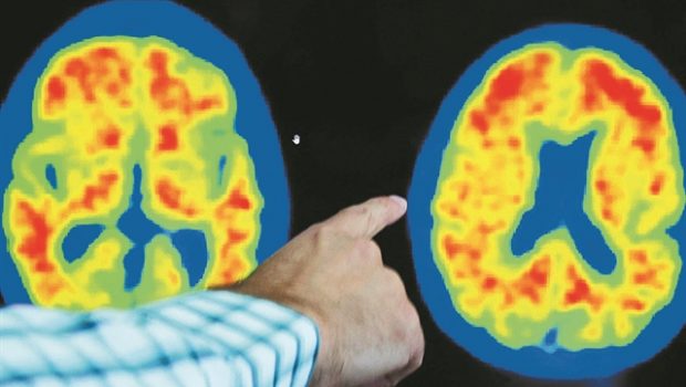 Δύο φάρμακα δίνουν ελπίδα σε ασθενείς με Αλτσχάιμερ