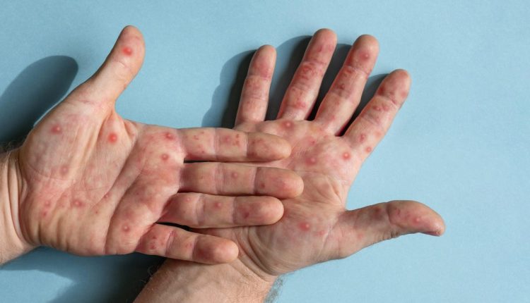 Μην κοιτάτε τώρα, αλλά το Mpox θα μπορούσε να επιστρέψει
