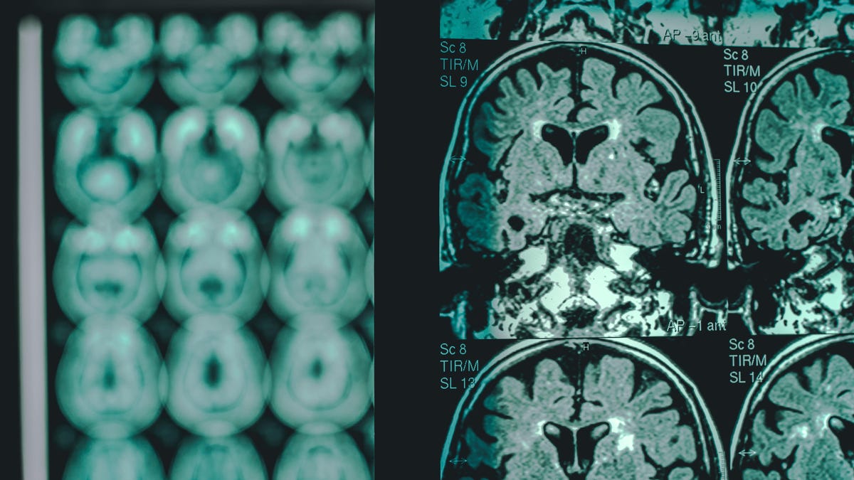 Η FDA Χορηγεί την Πρώτη Πλήρη Έγκριση σε Φάρμακο κατά του Αμυλοειδούς για τη Νόσο του Αλτσχάιμερ
