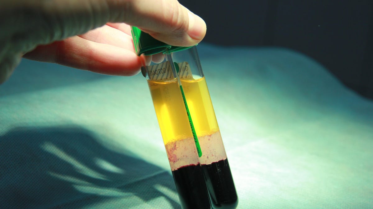 Το σπα «Vampire Facial» του Νέου Μεξικού συνδέεται με κρούσματα HIV
