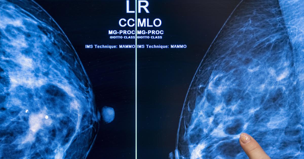 Ο προσυμπτωματικός έλεγχος καρκίνου με τη βοήθεια τεχνητής νοημοσύνης θα μπορούσε να μειώσει τον φόρτο εργασίας των ακτινολόγων στο μισό
