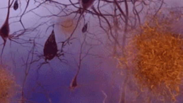 Εξέταση αίματος διαπιστώνει την Αλτσχάιμερ με ακρίβεια