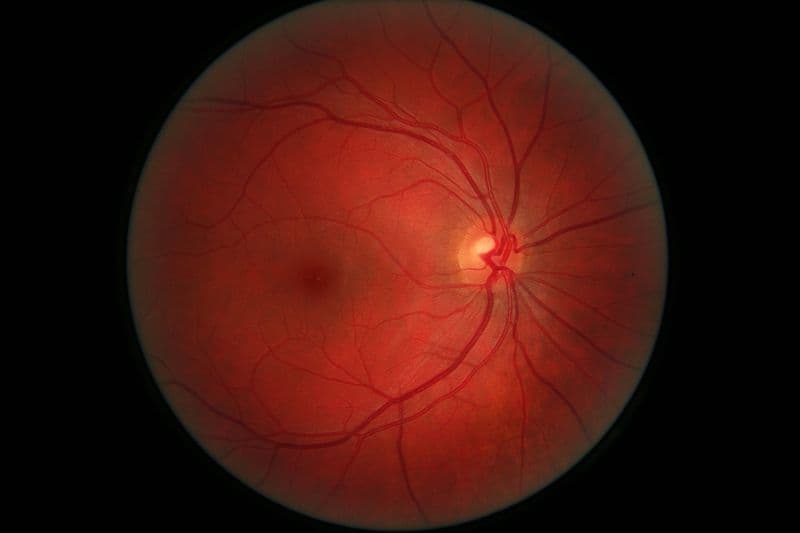 Πώς τα μάτια προσφέρουν πρόβλεψη για πλήθος σωματικών νόσων - 800px Righ eye retina - TechWar.GR