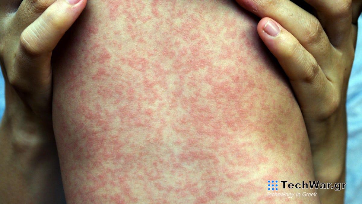 Η επιδημία ιλαράς του Philly χειροτερεύει