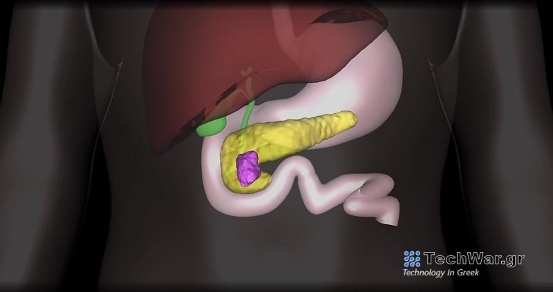 Νέο δρόμο κατά του καρκίνου του παγκρέατος δείχνει φάρμακο για τη στηθάγχη