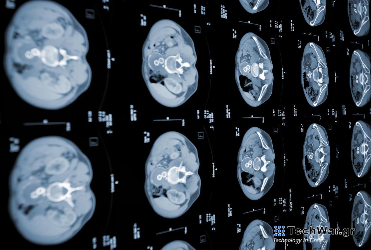 Οι ειδικοί του MIT αναπτύσσουν μοντέλα AI που μπορούν να ανιχνεύσουν έγκαιρα τον καρκίνο του παγκρέατος
