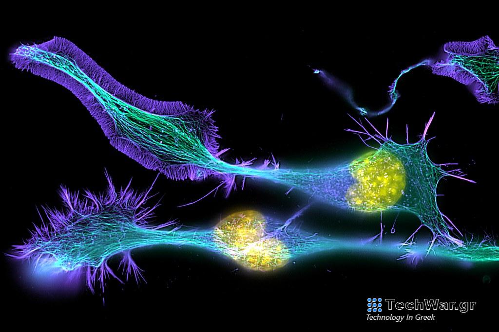 Σκλήρυνση κατά πλάκας: Αρχαίο DNA αποκαλύπτει το λόγο για τα υψηλά ποσοστά στην Ευρώπη