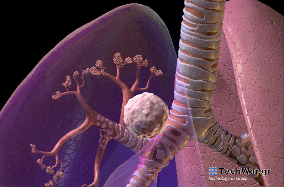 Καρκίνος: Δύο είναι οι βασικοί τομείς που δημιουργούν τις ανισότητες στη φροντίδα ασθενών