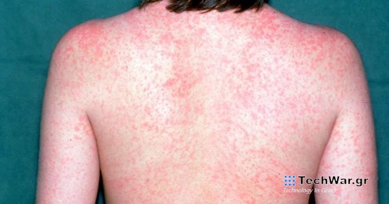 Ρήγμα στο τείχος ανοσίας για πρόληψη από ιλαρά